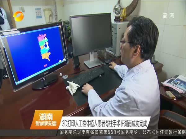 3D打印人工椎体植入患者脊柱手术在湖南成功完成
